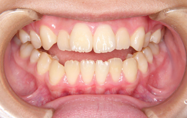 歯並びの乱れとその影響 大泉学園の矯正歯科 よしかわ矯正歯科