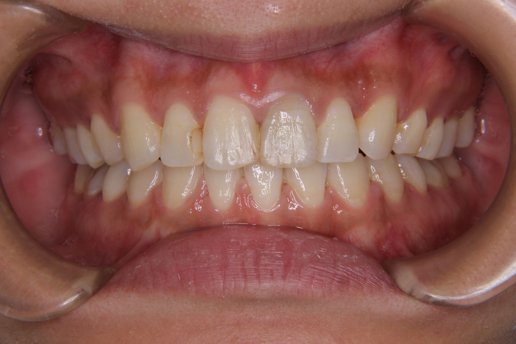 【30代 女性】上顎前歯のがたがた歯・下顎前歯一本欠損（先天欠如）の矯正歯科治療｜よしかわ矯正歯科 症例